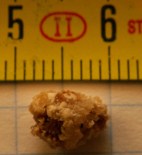 Kidney Stone, low back pain- Los Angeles chiropractor